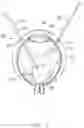 Fig. 04 - Vitrectomy probe interfacing component