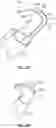 Fig. 13 - Ophthalmic knife and methods of use