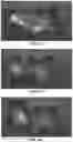 Fig. 11 - Bioerodible polyester polymer axitinib ocular implants and related methods of use