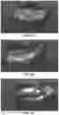 Fig. 12 - Bioerodible polyester polymer axitinib ocular implants and related methods of use