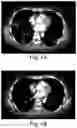 Fig. 02 - TREATMENT OF CANCER
