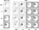 Fig. 01 - Atlas registration for resting state network mapping in patients with brain tumors