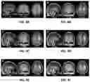 Fig. 05 - Atlas registration for resting state network mapping in patients with brain tumors