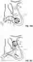 Fig. 15 - Catheter device for placing a sensor