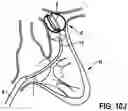 Fig. 16 - Catheter device for placing a sensor