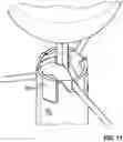Fig. 17 - Catheter device for placing a sensor
