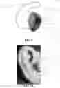Fig. 06 - Hearing enhancement and protection device