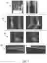 Fig. 02 - ULTRASONIC METHODS FOR TRACKING STRESS FRACTURES OF BONE