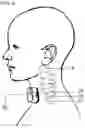 Fig. 08 - Devices and methods for nerve stimulation
