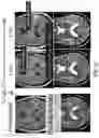 Fig. 07 - Systems and methods for quantifying multiscale competitive landscapes of clonal diversity in glioblastoma