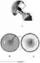 Fig. 06 - Prosthesis for hip replacement with polyethylene head and anti-rotational intra-prosthetic assembly