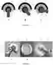 Fig. 07 - Prosthesis for hip replacement with polyethylene head and anti-rotational intra-prosthetic assembly