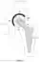 Fig. 08 - Prosthesis for hip replacement with polyethylene head and anti-rotational intra-prosthetic assembly
