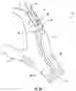 Fig. 03 - Wearable device capable of inducing electro-muscular incapacitation