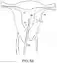 Fig. 06 - Methods and systems for controlled deployment of needles in tissue