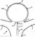 Fig. 01 - Electrolytic and mechanical detachment for implant delivery systems