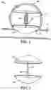 Fig. 02 - Intra-aneurysm devices