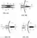 Fig. 07 - Intra-aneurysm devices