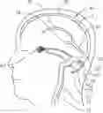 Fig. 01 - Systems and methods for retrograde perfusion and clearance of emboli