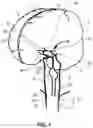 Fig. 02 - Systems and methods for retrograde perfusion and clearance of emboli