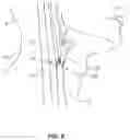 Fig. 06 - Systems and methods for retrograde perfusion and clearance of emboli