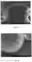 Fig. 02 - Bioimplant