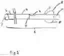 Fig. 02 - Bypass catheter