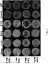Fig. 06 - ENHANCED TREATMENT VOLUME AND SELECTIVE ABLATION USING ELECTROPORATION WITH ADJUVANT CALCIUM