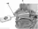 Fig. 01 - Device and method to selectively and reversibly modulate a nervous system structure to inhibit pain