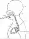 Fig. 01 - TRANS-ESOPHAGEAL TONOMETRY