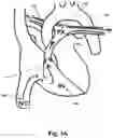 Fig. 02 - Pulmonary embolism apparatus