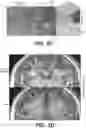 Fig. 09 - System, method and computer-accessible medium for facilitating noise removal in magnetic resonance imaging
