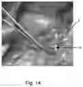 Fig. 09 - Systems and methods configured to deploy cuffs onto biological structures