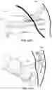 Fig. 48 - Systems, devices, and methods for forming anastomoses