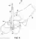 Fig. 04 - Guided punch for talar augments