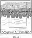 Fig. 147 - Systems, devices and methods for fractional resection, fractional skin grafting, fractional scar reduction and fractional tattoo removal