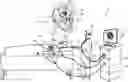 Fig. 01 - Identifying pulmonary vein occlusion by dimension deformations of balloon catheter