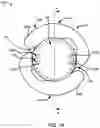 Fig. 02 - Adjustable intraocular lenses and methods of post-operatively adjusting intraocular lenses