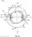 Fig. 02 - Accommodating intraocular lenses with toric surface