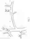 Fig. 02 - Methods and apparatus for treating neurovascular venous outflow obstruction