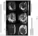 Fig. 05 - Modified fibroblast growth factor 21 (FGF-21) for use in methods for treating nonalcoholic steatohepatitis (NASH)