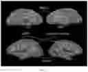 Fig. 11 - Systems, methods and media for detecting and facilitating an effortful mental task by providing real-time deep brain stimulation