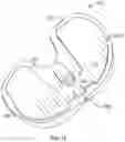 Fig. 17 - Prosthetic knee implant systems and methods with linked tibial rotation