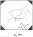 Fig. 06 - Method of using a manually-operated light plane generating module to make accurate measurements of the dimensions of an object seen in an image taken by an endoscopic camera