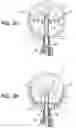Fig. 07 - Aneurysm treatment device