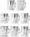 Fig. 131 - Prosthetic capsular devices, systems, and methods