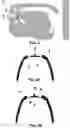 Fig. 04 - BUCCAL VALVE