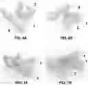 Fig. 05 - BUCCAL VALVE