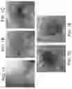 Fig. 02 - Device and method for enhanced visualization of the small intestine