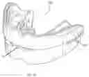 Fig. 05 - Oral appliance